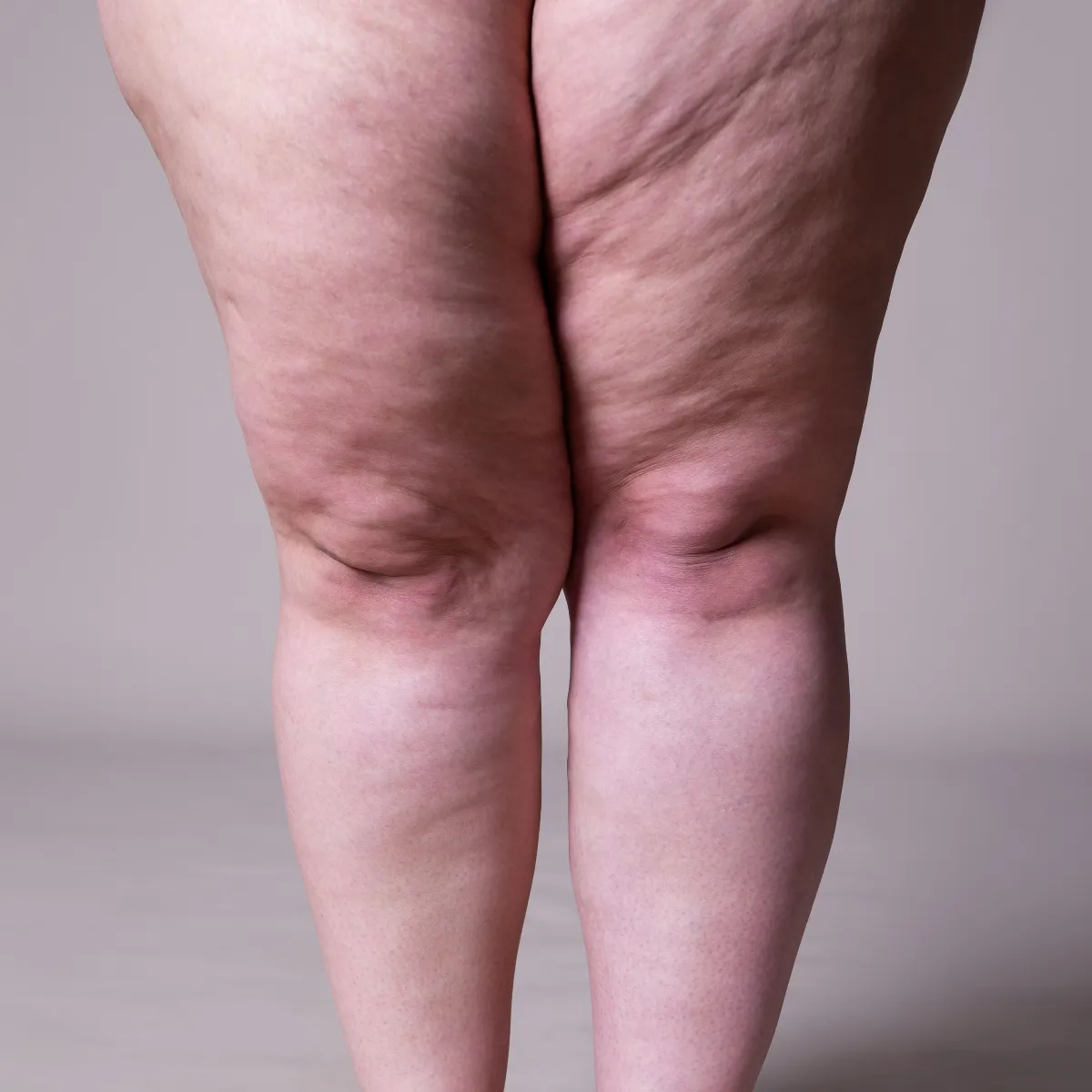 Lipedema